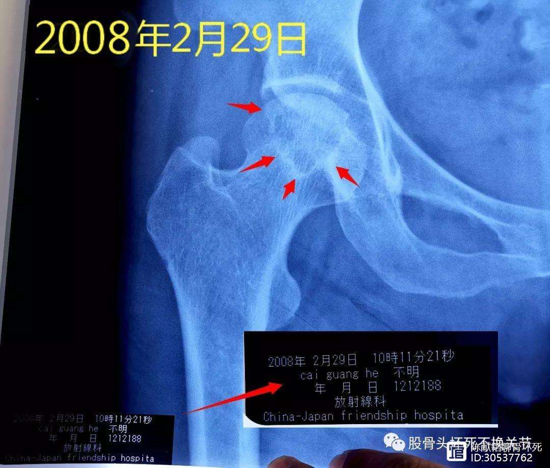 鸡西人工骨头医保报销多少(人工骨头医保报销多少比例)