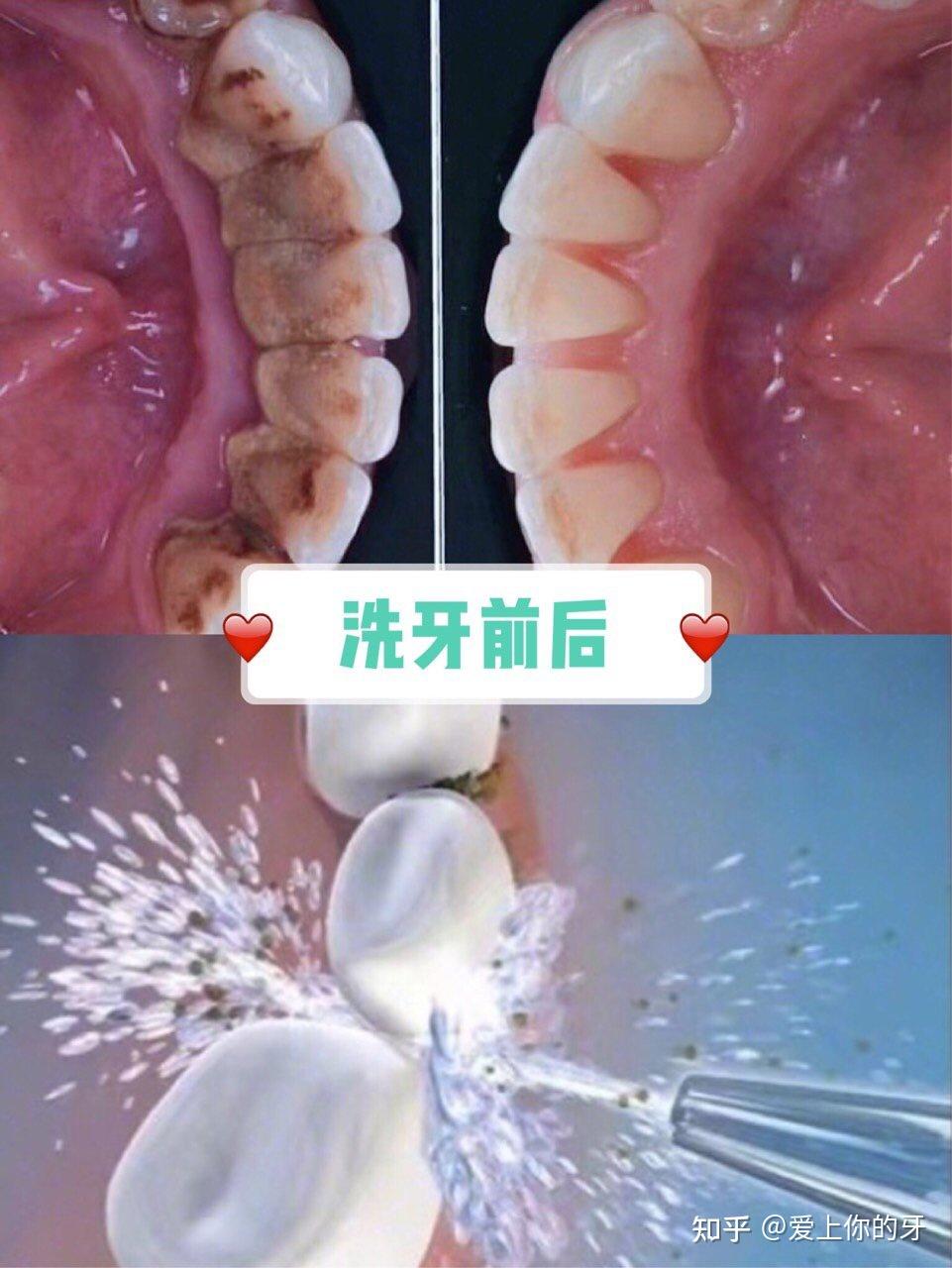 鸡西洗牙可以用医保吗(洗牙可以用医保吗,报销比例多少)